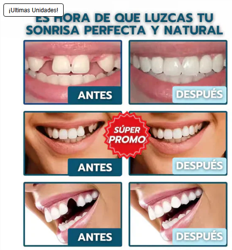 Carillas Instant Smile™: ocultan manchas, espacios y torceduras en minutos 🔥OFERTA 2X1🔥