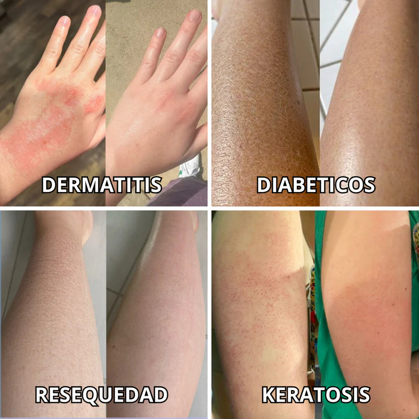 DiabeSkin - Ultrahumectante